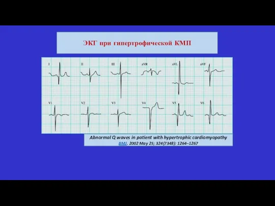 Abnormal Q waves in patient with hypertrophic cardiomyopathy BMJ. 2002 May