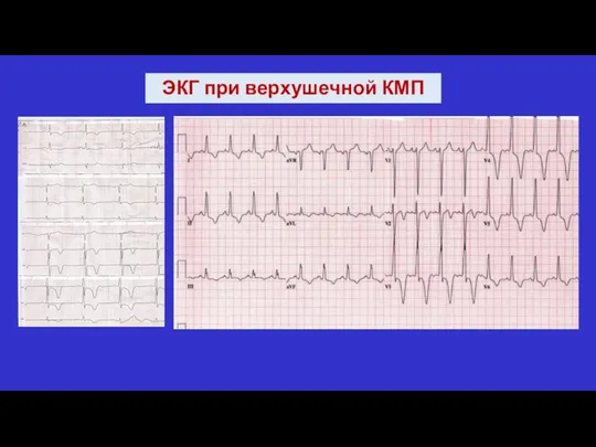 ЭКГ при верхушечной КМП