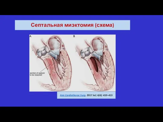 Септальная миэктомия (схема) Ann Cardiothorac Surg. 2017 Jul; 6(4): 410–415