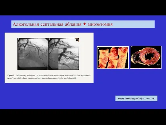 Алкогольная септальная аблация + миоэктомия Heart. 2006 Dec; 92(12): 1773–1778.