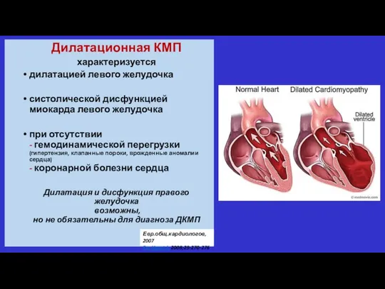 Дилатационная КМП характеризуется дилатацией левого желудочка систолической дисфункцией миокарда левого желудочка