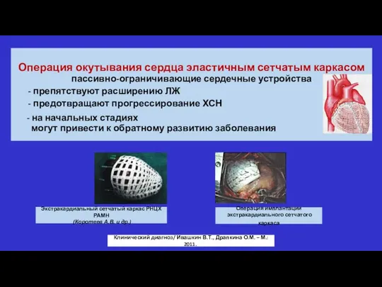 Операция окутывания сердца эластичным сетчатым каркасом пассивно-ограничивающие сердечные устройства - препятствуют