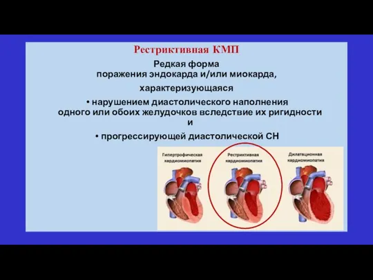 Рестриктивная КМП Редкая форма поражения эндокарда и/или миокарда, характеризующаяся нарушением диастолического