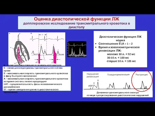 Оценка диастолической функции ЛЖ допплеровское исследование трансмитрального кровотока в диастолу Динамика