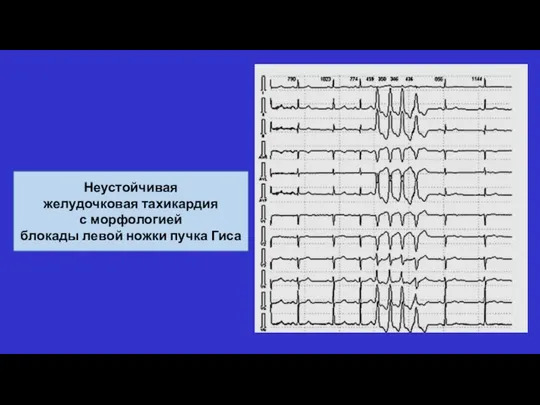 Неустойчивая желудочковая тахикардия с морфологией блокады левой ножки пучка Гиса