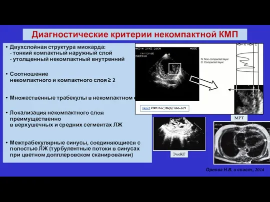 Диагностические критерии некомпактной КМП Двухслойная структура миокарда: - тонкий компактный наружный