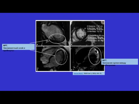 Yonsei Med J. 2018 Jan 1; 59(1): 63–71. МРТ. Затекание крови