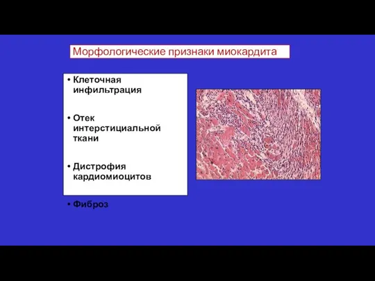 Морфологические признаки миокардита Клеточная инфильтрация Отек интерстициальной ткани Дистрофия кардиомиоцитов Фиброз