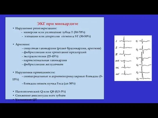 ЭКГ при миокардите Нарушение реполяризации: - инверсия или уплощение зубца Т