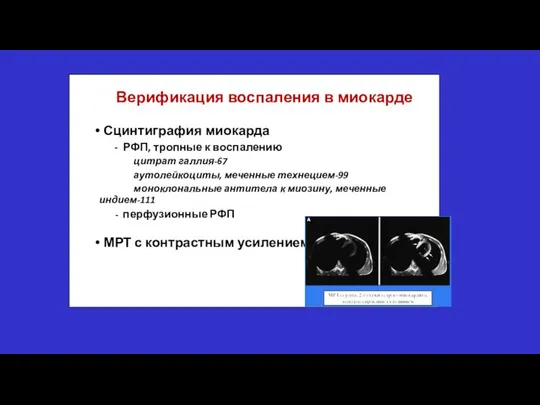 Верификация воспаления в миокарде Сцинтиграфия миокарда - РФП, тропные к воспалению