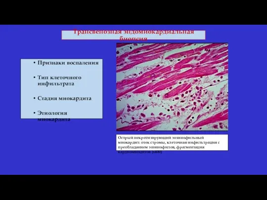 Трансвенозная эндомиокардиальная биопсия Признаки воспаления Тип клеточного инфильтрата Стадия миокардита Этиология