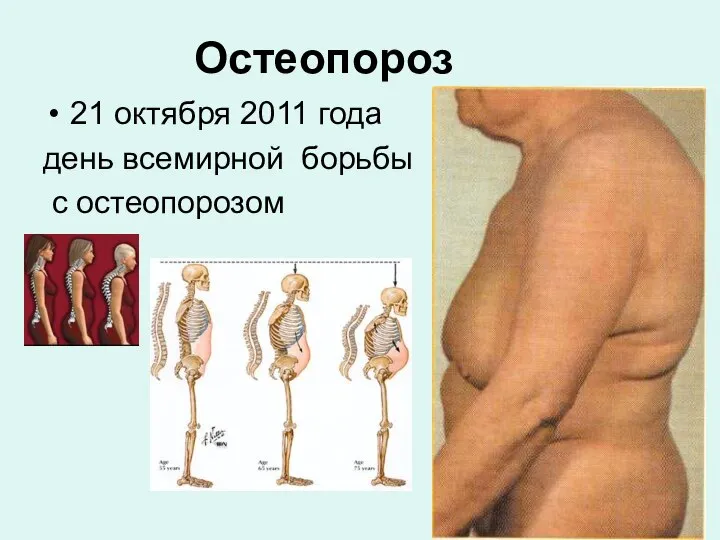 Остеопороз 21 октября 2011 года день всемирной борьбы с остеопорозом