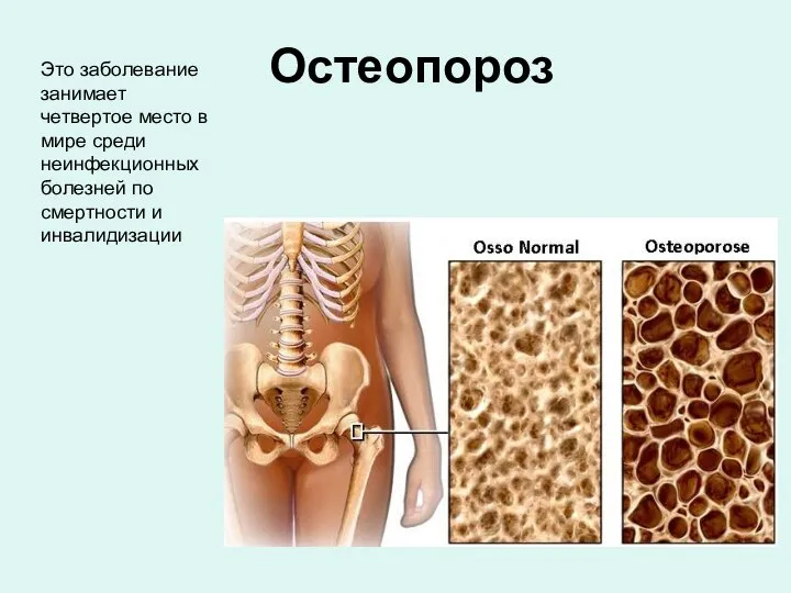 Остеопороз Это заболевание занимает четвертое место в мире среди неинфекционных болезней по смертности и инвалидизации