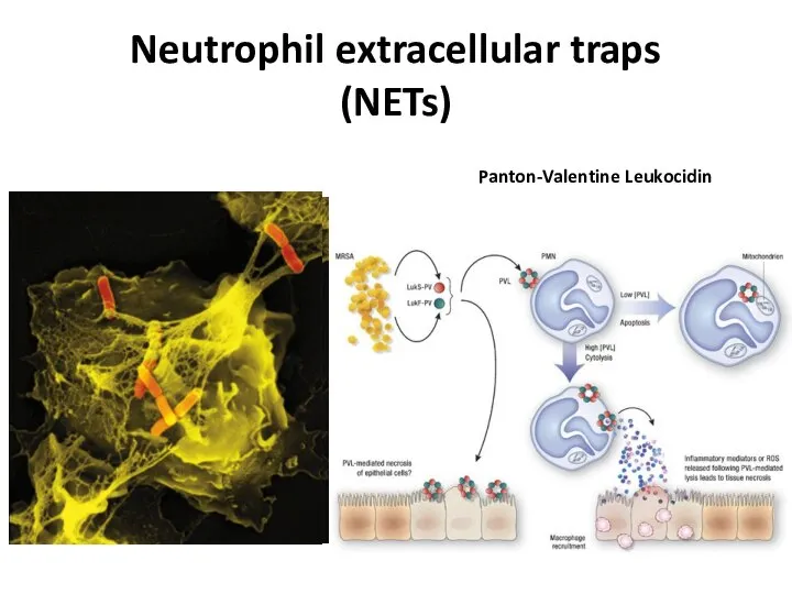 Neutrophil extracellular traps (NETs) Panton-Valentine Leukocidin