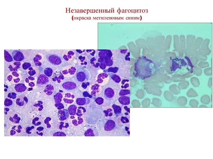 Незавершенный фагоцитоз (окраска метиленовым синим)