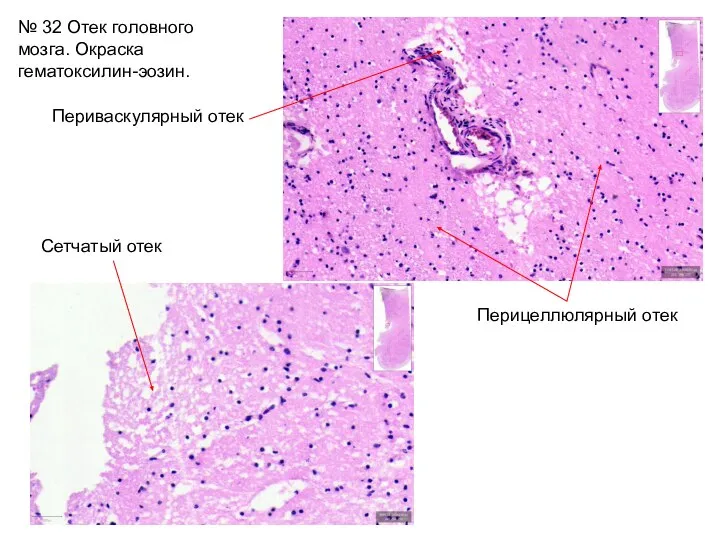 № 32 Отек головного мозга. Окраска гематоксилин-эозин. Сетчатый отек Периваскулярный отек Перицеллюлярный отек