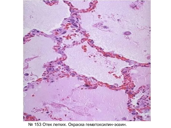 № 153 Отек легких. Окраска гематоксилин-эозин.