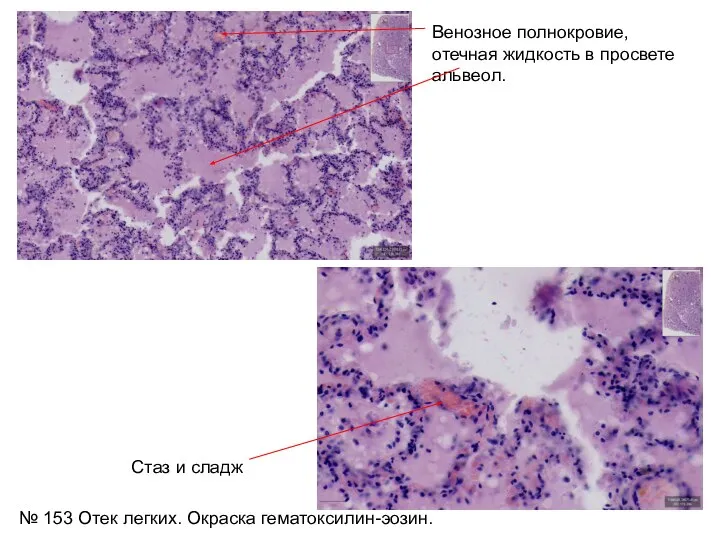 Венозное полнокровие, отечная жидкость в просвете альвеол. № 153 Отек легких. Окраска гематоксилин-эозин. Стаз и сладж