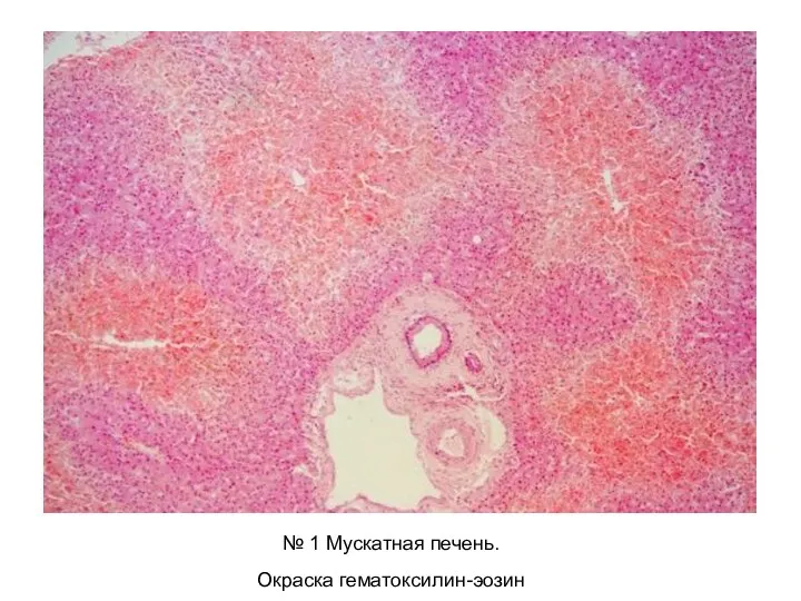 № 1 Мускатная печень. Окраска гематоксилин-эозин