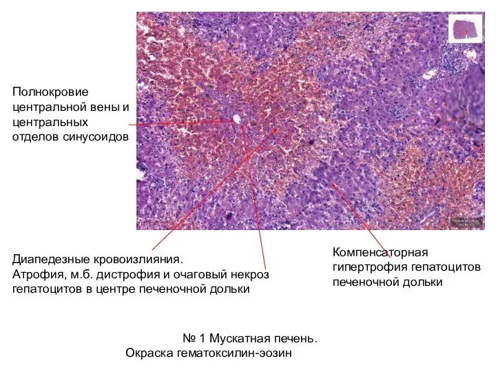 Диапедезные кровоизлияния. Атрофия, м.б. дистрофия и очаговый некроз гепатоцитов в центре