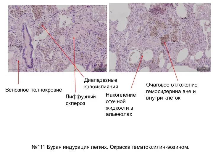 Очаговое отложение гемосидерина вне и внутри клеток Диапедезные крвоизлияния Венозное полнокровие