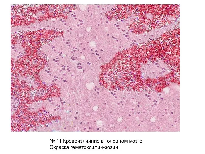 № 11 Кровоизлияние в головном мозге. Окраска гематоксилин-эозин.