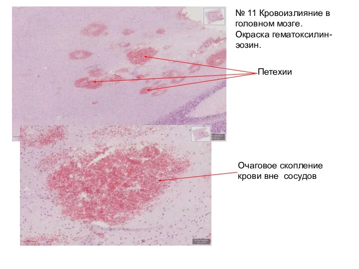 Очаговое скопление крови вне сосудов № 11 Кровоизлияние в головном мозге. Окраска гематоксилин-эозин. Петехии