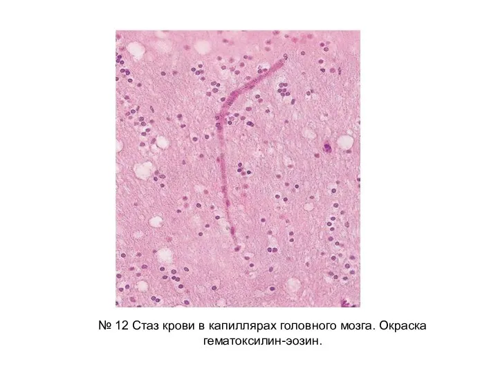 № 12 Стаз крови в капиллярах головного мозга. Окраска гематоксилин-эозин.