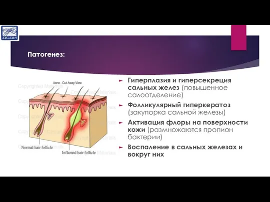 Патогенез: Гиперплазия и гиперсекреция сальных желез (повышенное салоотделение) Фолликулярный гиперкератоз (закупорка