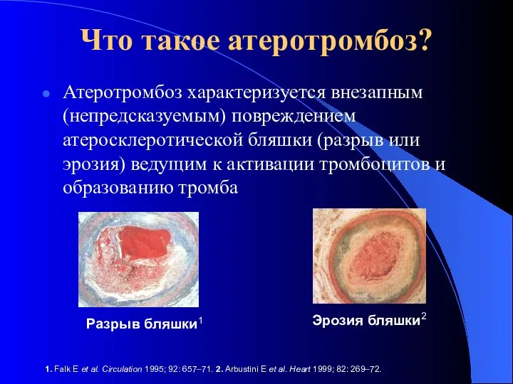 Что такое атеротромбоз? Атеротромбоз характеризуется внезапным (непредсказуемым) повреждением атеросклеротической бляшки (разрыв