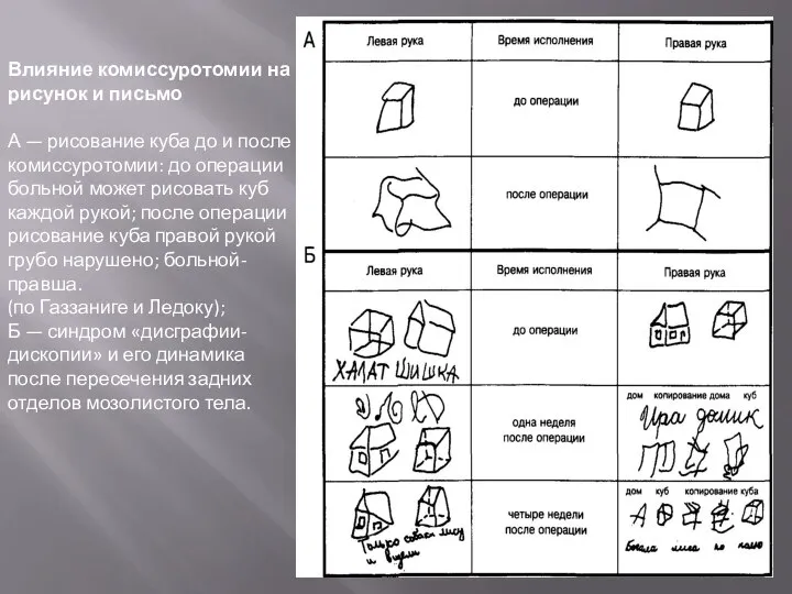 Влияние комиссуротомии на рисунок и письмо А — рисование куба до