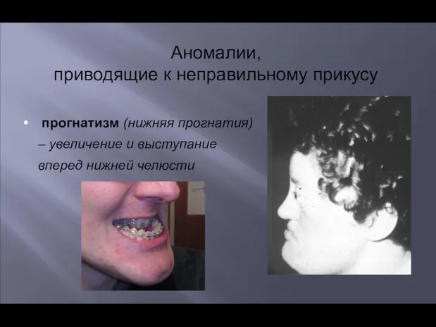 Аномалии, приводящие к неправильному прикусу прогнатизм (нижняя прогнатия) – увеличение и выступание вперед нижней челюсти
