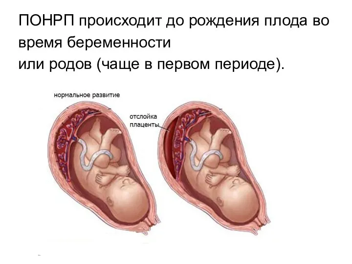 ПОНРП происходит до рождения плода во время беременности или родов (чаще в первом периоде).