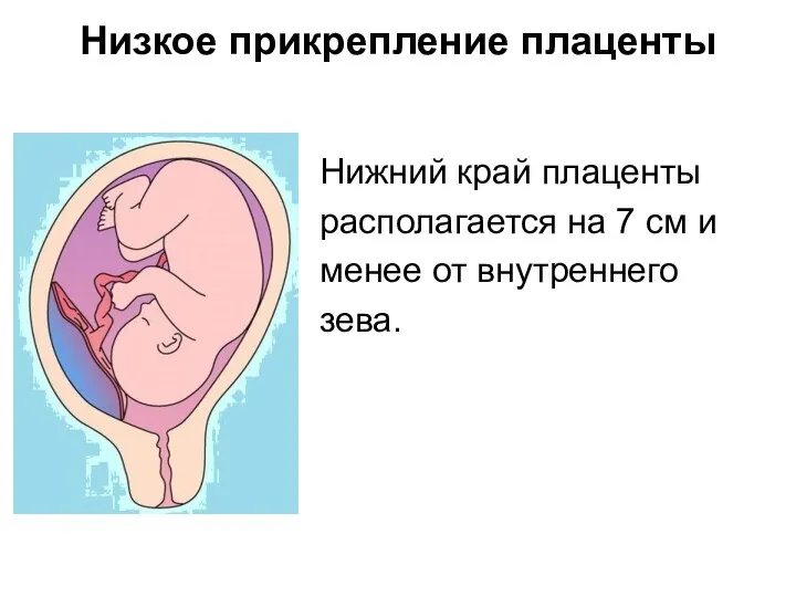 Низкое прикрепление плаценты Нижний край плаценты располагается на 7 см и менее от внутреннего зева.
