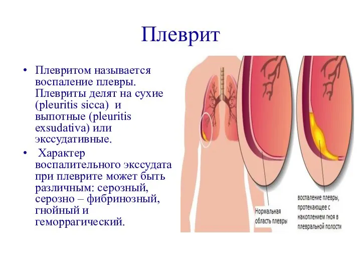 Плеврит Плевритом называется воспаление плевры. Плевриты делят на сухие (pleuritis sicca)