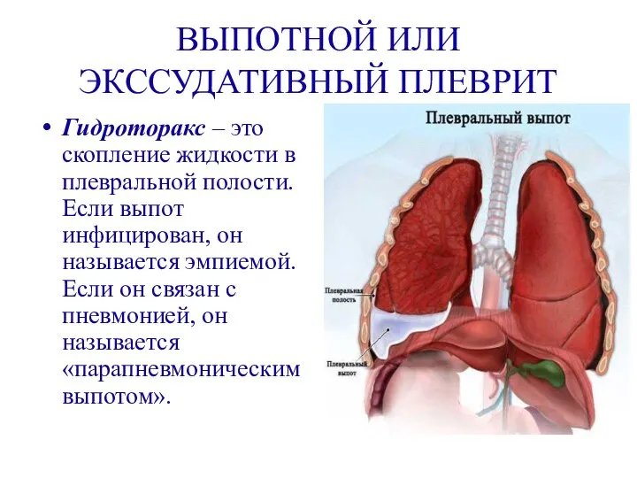 ВЫПОТНОЙ ИЛИ ЭКССУДАТИВНЫЙ ПЛЕВРИТ Гидроторакс – это скопление жидкости в плевральной