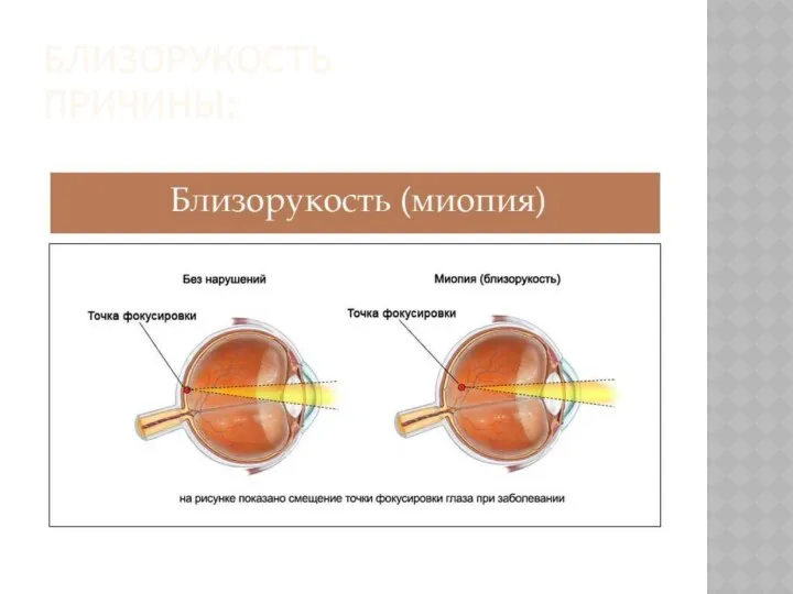 БЛИЗОРУКОСТЬ ПРИЧИНЫ: