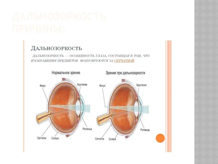 ДАЛЬНОЗОРКОСТЬ ПРИЧИНЫ: