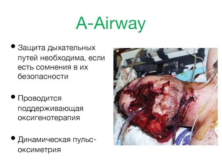 A-Airway Защита дыхательных путей необходима, если есть сомнения в их безопасности Проводится поддерживающая оксигенотерапия Динамическая пульс-оксиметрия