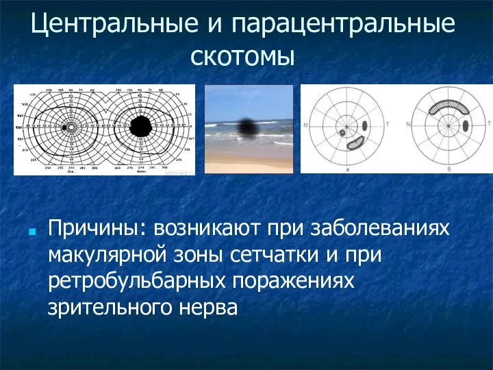 Центральные и парацентральные скотомы Причины: возникают при заболеваниях макулярной зоны сетчатки