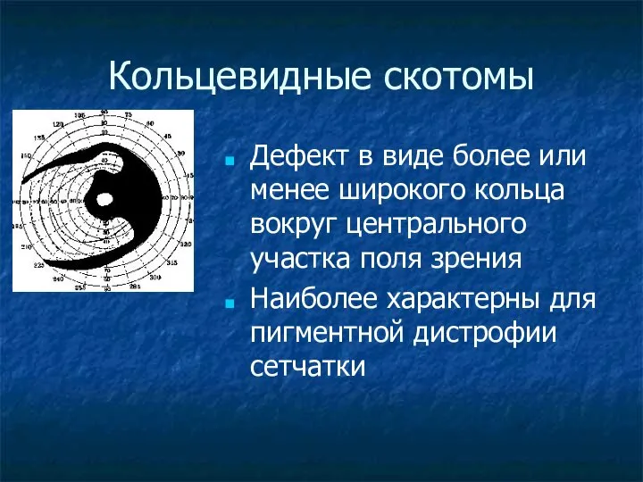 Кольцевидные скотомы Дефект в виде более или менее широкого кольца вокруг