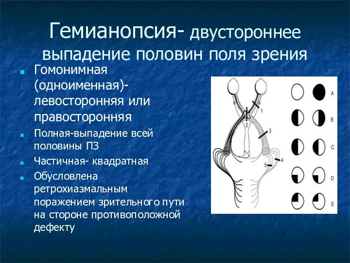 Гемианопсия- двустороннее выпадение половин поля зрения Гомонимная (одноименная)- левосторонняя или правосторонняя