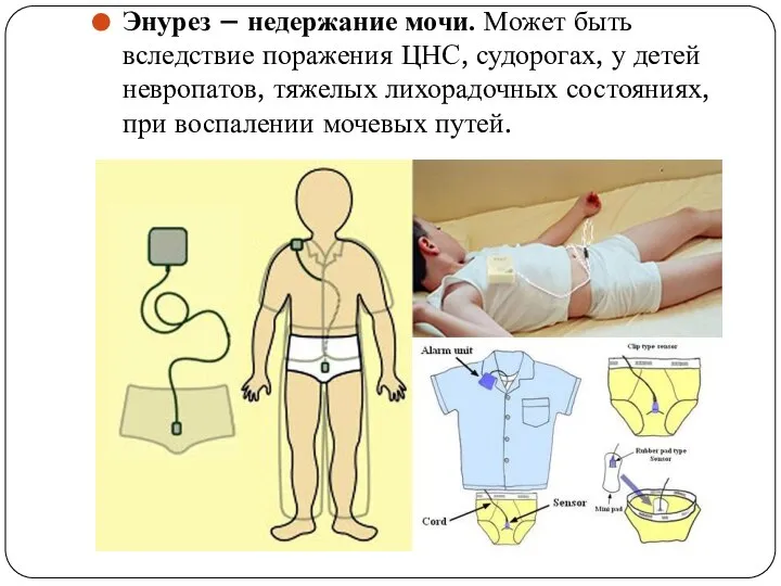 Энурез – недержание мочи. Может быть вследствие поражения ЦНС, судорогах, у