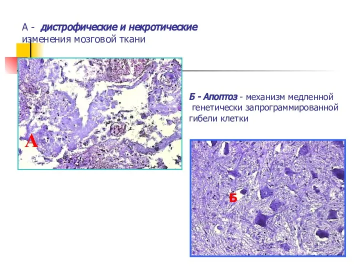 А - дистрофические и некротические изменения мозговой ткани А Б -