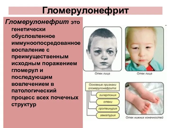 Гломерулонефрит Гломерулонефрит это генетически обусловленное иммуноопосредованное воспаление с преимущественным исходным поражением