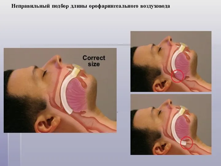 Неправильный подбор длины орофарингеального воздуховода