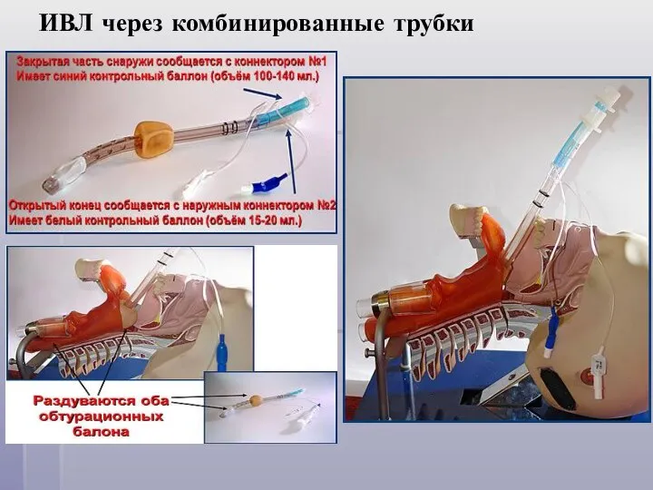 ИВЛ через комбинированные трубки