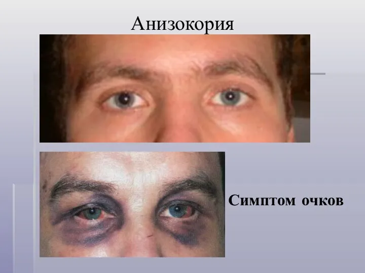 Анизокория Симптом очков