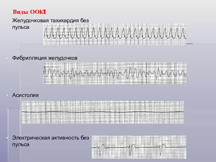 Виды ООК! Желудочковая тахикардия без пульса Фибрилляция желудочков Асистолия Электрическая активность без пульса