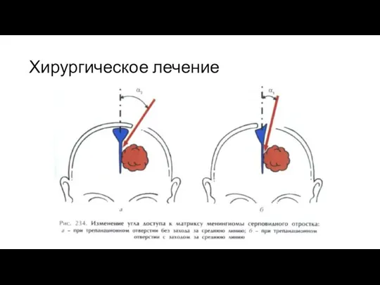 Хирургическое лечение